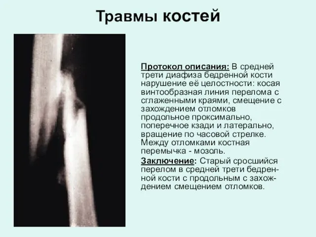 Травмы костей Протокол описания: В средней трети диафиза бедренной кости