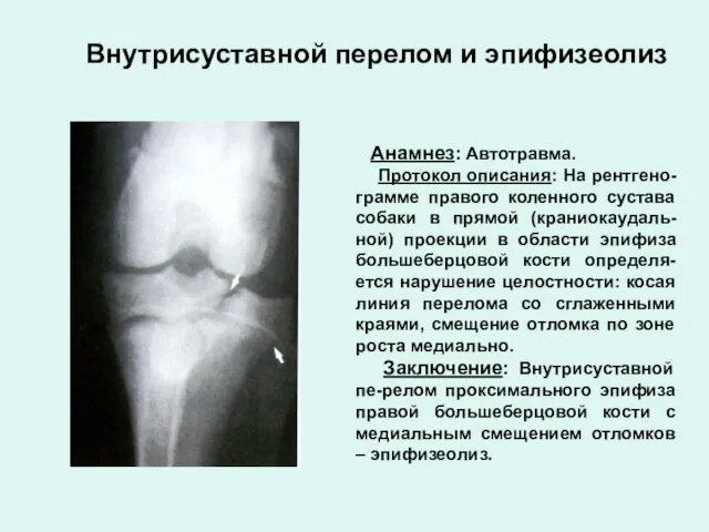 Внутрисуставной перелом и эпифизеолиз Анамнез: Автотравма. Протокол описания: На рентгено-грамме правого коленного сустава