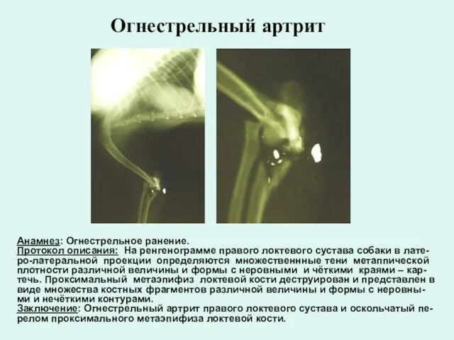Анамнез: Огнестрельное ранение. Протокол описания: На ренгенограмме правого локтевого сустава