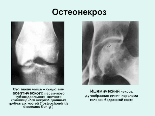 Остеонекроз Суставная мышь – следствие асептического первичного субхондрального костного клиновидного некроза длинных трубчатых