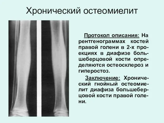 Хронический остеомиелит Протокол описания: На рентгенограммах костей правой голени в