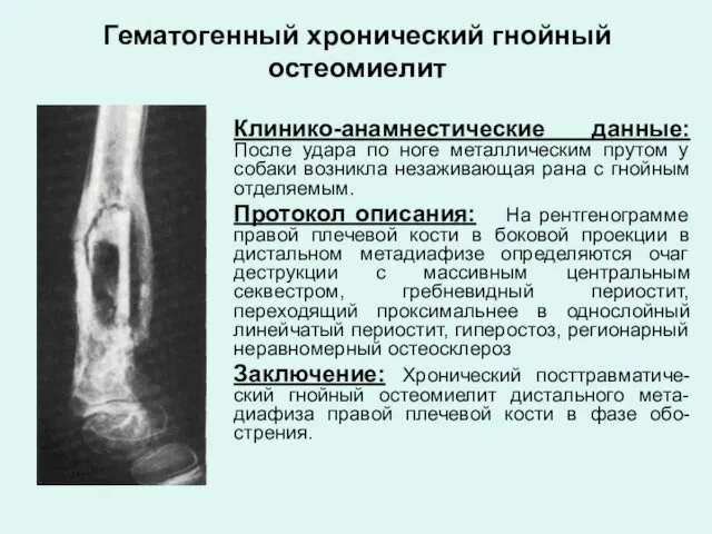 Гематогенный хронический гнойный остеомиелит Клинико-анамнестические данные: После удара по ноге металлическим прутом у