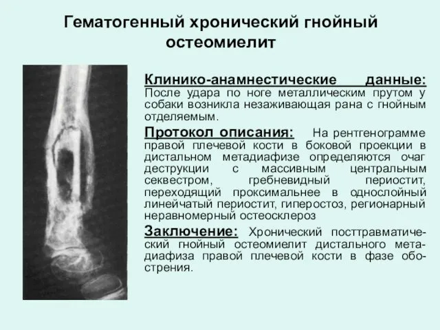 Гематогенный хронический гнойный остеомиелит Клинико-анамнестические данные: После удара по ноге