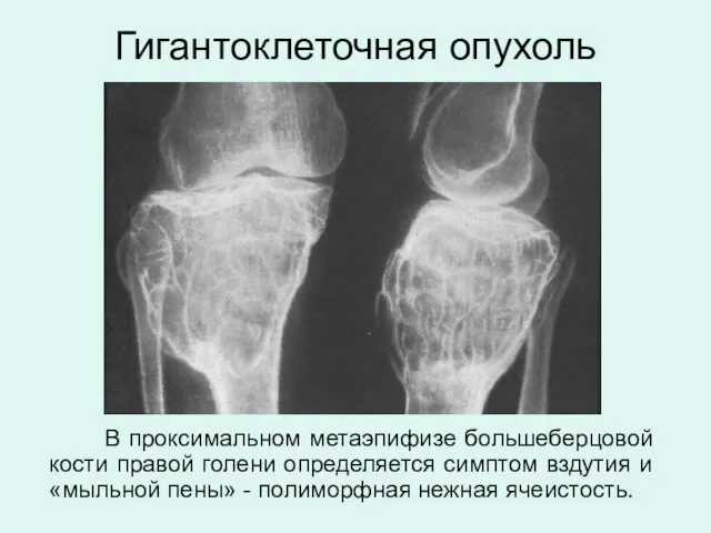 Гигантоклеточная опухоль В проксимальном метаэпифизе большеберцовой кости правой голени определяется