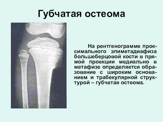 Губчатая остеома На рентгенограмме прок-симального эпиметадиафиза большеберцовой кости в пря-мой проекции медиально в