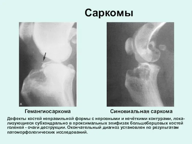 Саркомы Гемангиосаркома Синовиальная саркома Дефекты костей неправильной формы с неровными