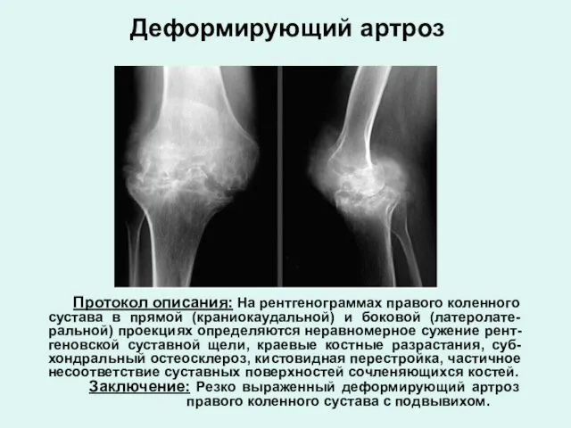 Протокол описания: На рентгенограммах правого коленного сустава в прямой (краниокаудальной)