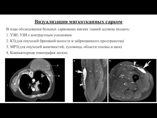 Визуализация мягкотканных сарком В план обследования больных саркомами мягких тканей