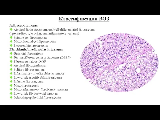 Классификация ВОЗ Adipocytic tumours ◆ Atypical lipomatous tumours/well-differentiated liposarcoma (lipoma-like,