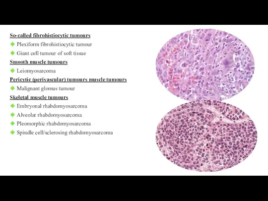 So-called fibrohistiocytic tumours ◆ Plexiform fibrohistiocytic tumour ◆ Giant cell