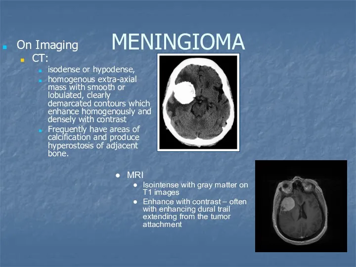 MENINGIOMA On Imaging CT: isodense or hypodense, homogenous extra-axial mass with smooth or