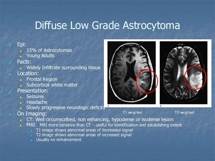 Diffuse Low Grade Astrocytoma Epi: 15% of Astrocytomas Young Adults Facts: Widely Infiltrate