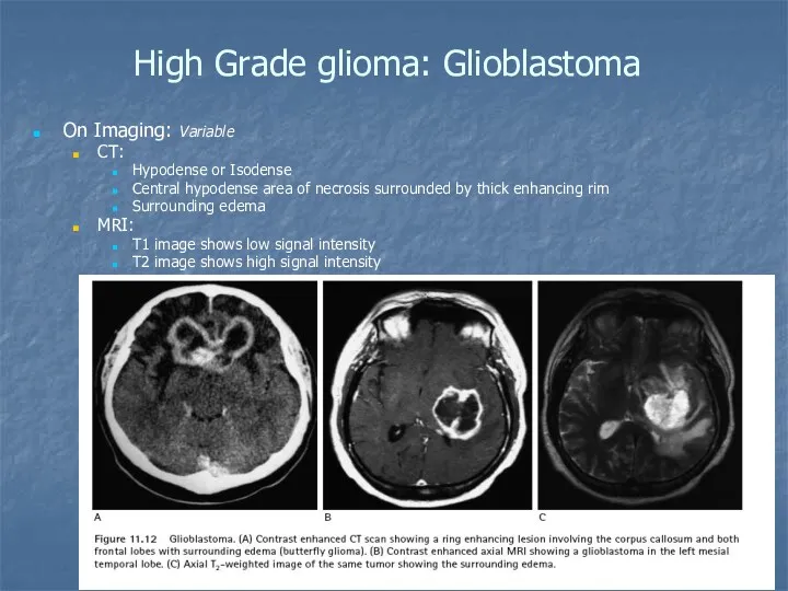 High Grade glioma: Glioblastoma On Imaging: Variable CT: Hypodense or Isodense Central hypodense