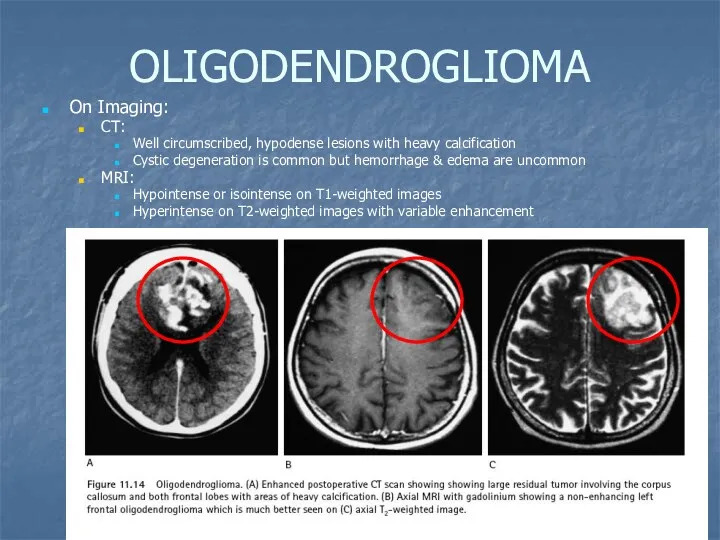 OLIGODENDROGLIOMA On Imaging: CT: Well circumscribed, hypodense lesions with heavy calcification Cystic degeneration