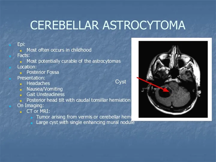 CEREBELLAR ASTROCYTOMA Epi: Most often occurs in childhood Facts: Most potentially curable of