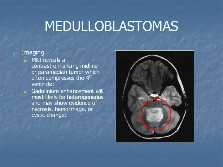 MEDULLOBLASTOMAS Imaging MRI reveals a contrast-enhancing midline or paramedian tumor which often compresses