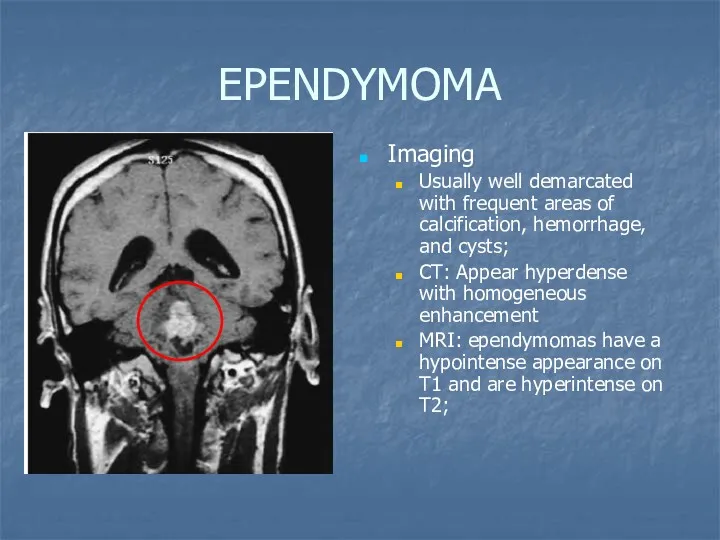 EPENDYMOMA Imaging Usually well demarcated with frequent areas of calcification, hemorrhage, and cysts;