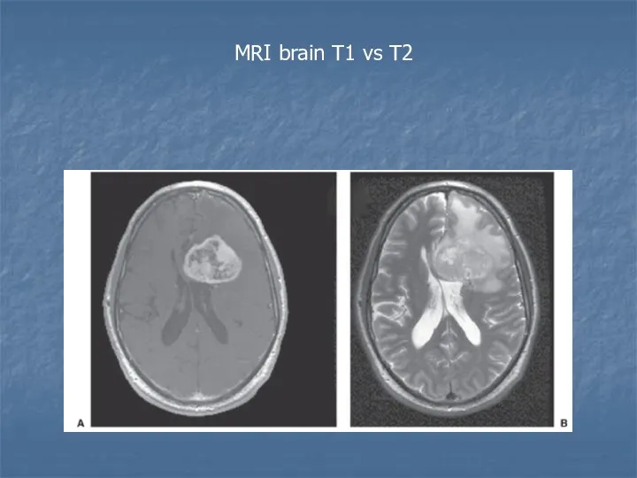 MRI brain T1 vs T2