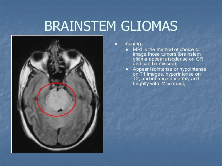 BRAINSTEM GLIOMAS Imaging MRI is the method of choice to image those tumors