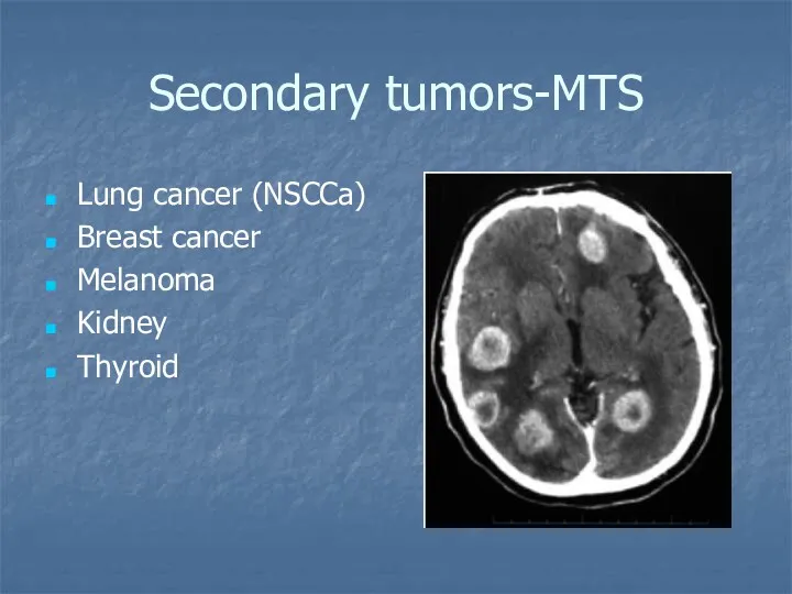 Secondary tumors-MTS Lung cancer (NSCCa) Breast cancer Melanoma Kidney Thyroid