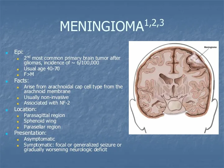 MENINGIOMA1,2,3 Epi: 2nd most common primary brain tumor after gliomas, incidence of ~