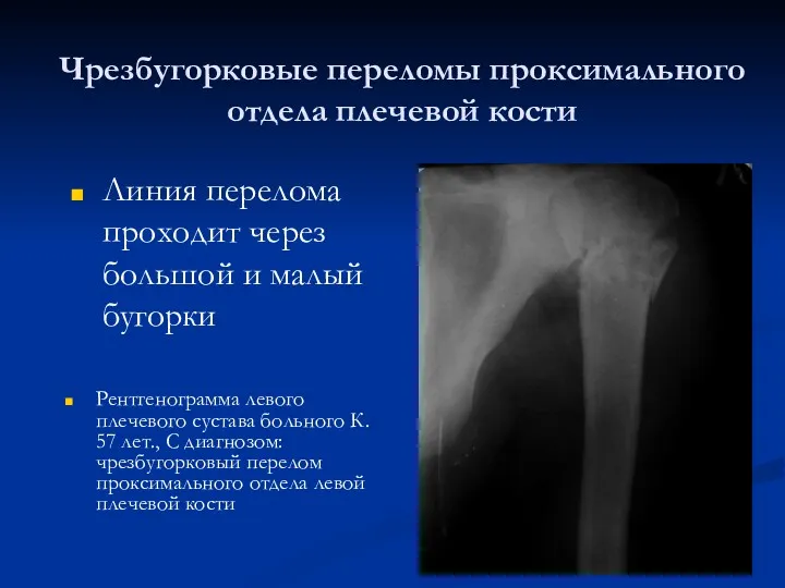 Чрезбугорковые переломы проксимального отдела плечевой кости Рентгенограмма левого плечевого сустава больного К. 57