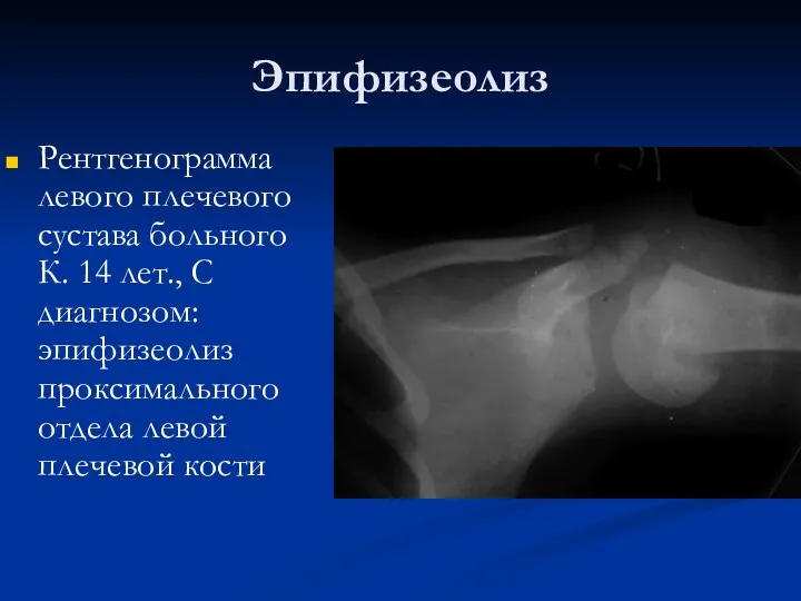 Эпифизеолиз Рентгенограмма левого плечевого сустава больного К. 14 лет., С диагнозом: эпифизеолиз проксимального