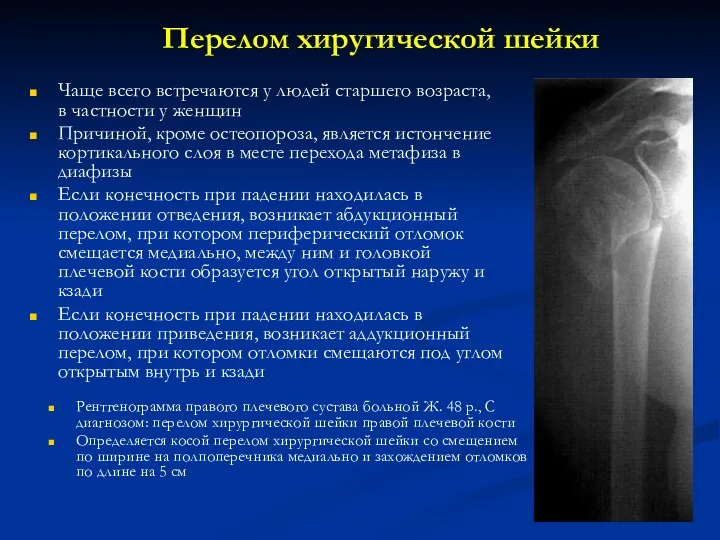 Перелом хиругической шейки Рентгенограмма правого плечевого сустава больной Ж. 48 р., С диагнозом: