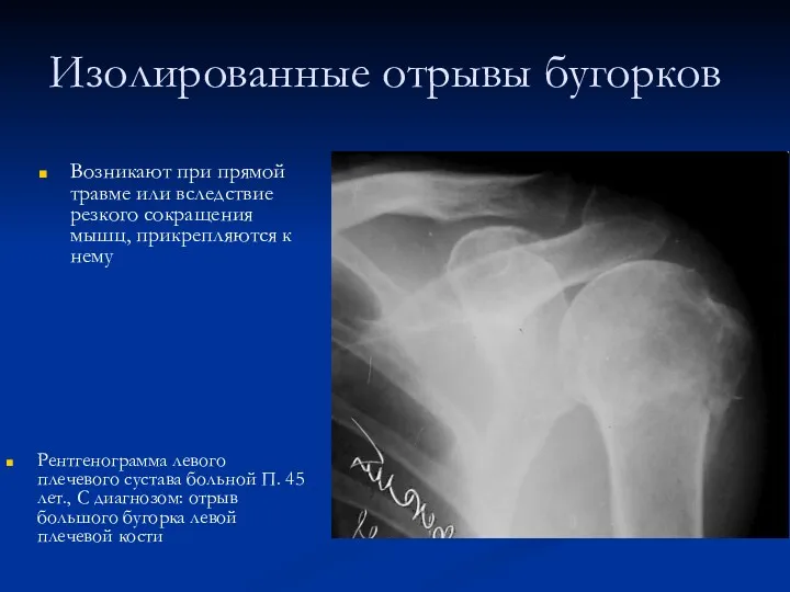 Изолированные отрывы бугорков Рентгенограмма левого плечевого сустава больной П. 45 лет., С диагнозом: