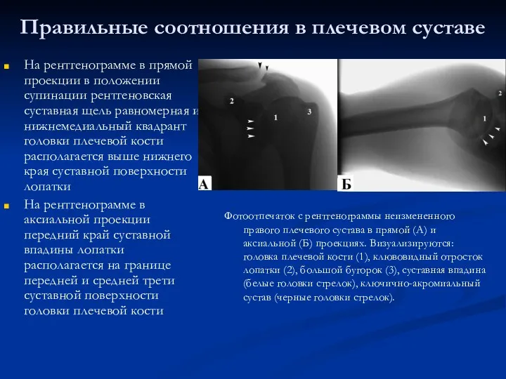 Правильные соотношения в плечевом суставе На рентгенограмме в прямой проекции