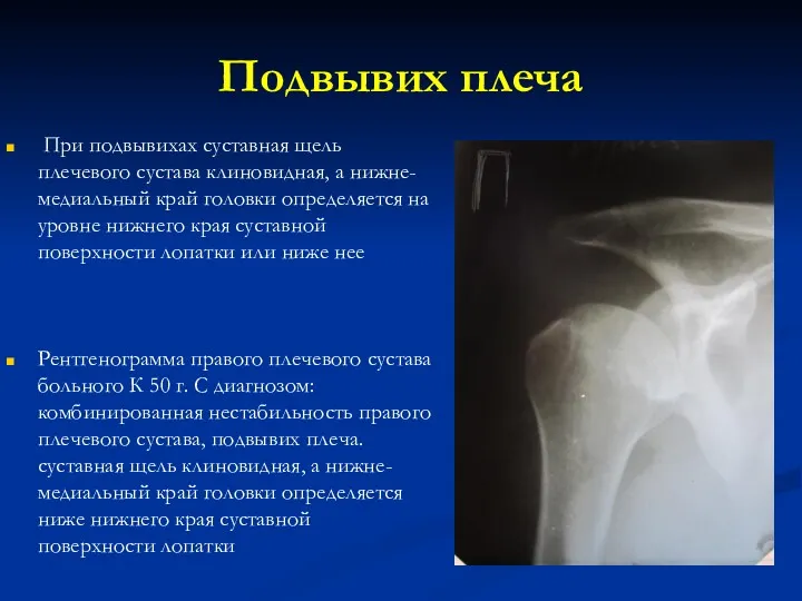 Подвывих плеча Рентгенограмма правого плечевого сустава больного К 50 г. С диагнозом: комбинированная