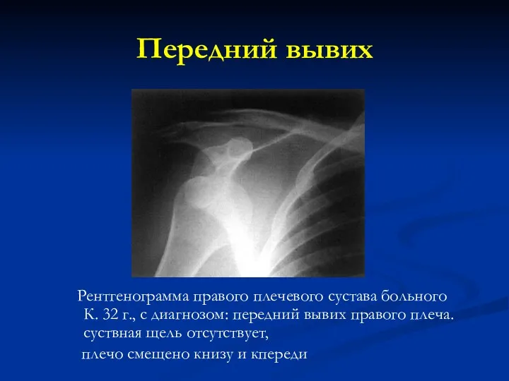 Передний вывих Рентгенограмма правого плечевого сустава больного К. 32 г., с диагнозом: передний