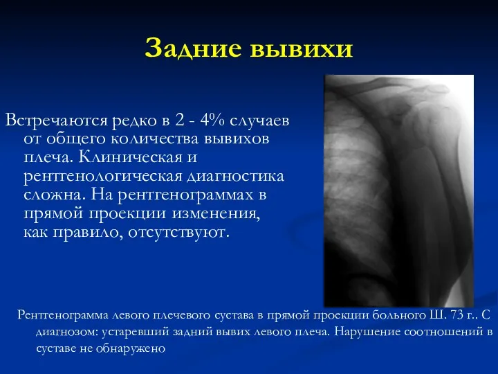 Задние вывихи Рентгенограмма левого плечевого сустава в прямой проекции больного Ш. 73 г..