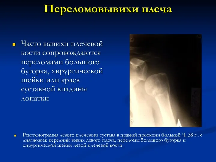 Переломовывихи плеча Часто вывихи плечевой кости сопровождаются переломами большого бугорка, хирургической шейки или