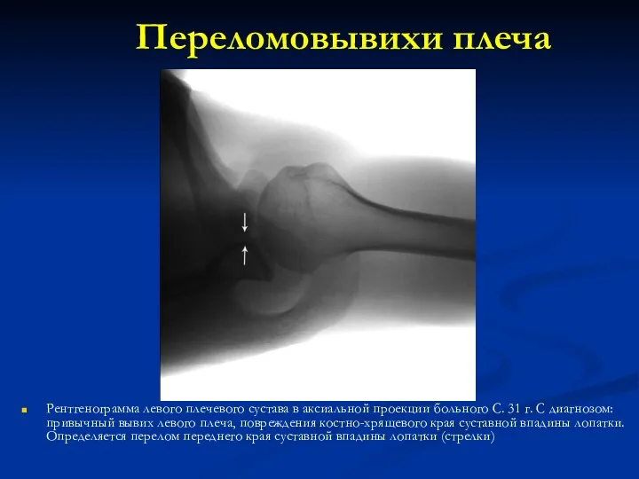 Переломовывихи плеча Рентгенограмма левого плечевого сустава в аксиальной проекции больного С. 31 г.