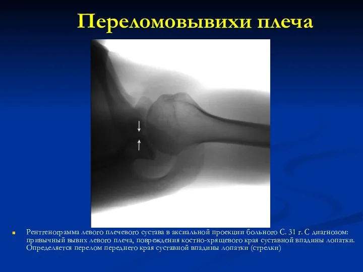 Переломовывихи плеча Рентгенограмма левого плечевого сустава в аксиальной проекции больного