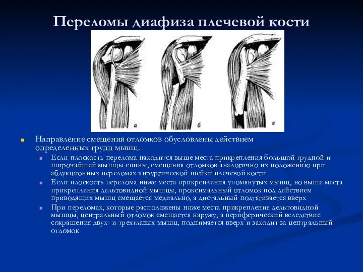 Переломы диафиза плечевой кости Направление смещения отломков обусловлены действием определенных групп мышц. Если