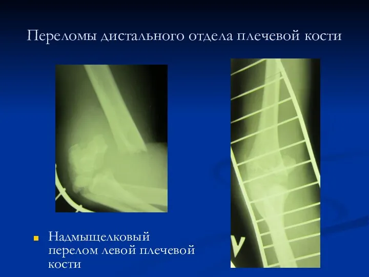 Переломы дистального отдела плечевой кости Надмыщелковый перелом левой плечевой кости