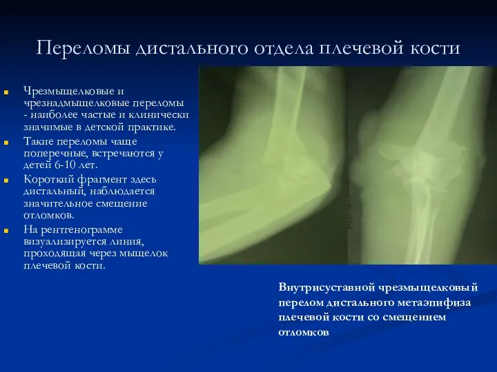 Переломы дистального отдела плечевой кости Чрезмыщелковые и чрезнадмыщелковые переломы - наиболее частые и