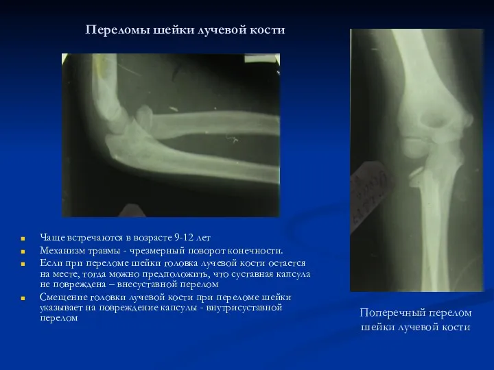 Поперечный перелом шейки лучевой кости Чаще встречаются в возрасте 9-12