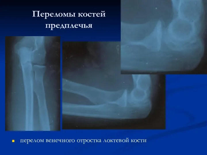Переломы костей предплечья перелом венечного отростка локтевой кости
