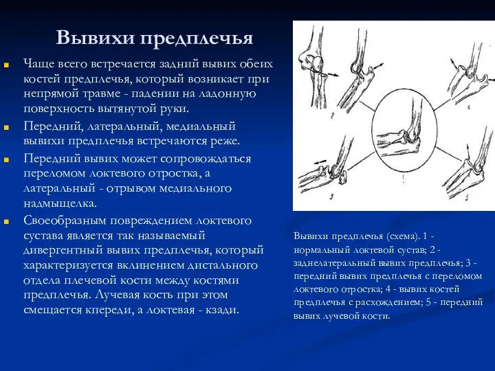 Вывихи предплечья Чаще всего встречается задний вывих обеих костей предплечья,