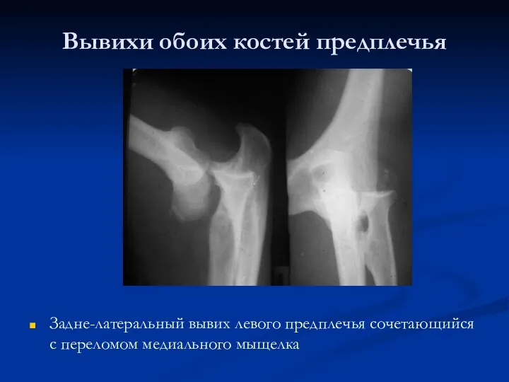 Вывихи обоих костей предплечья Задне-латеральный вывих левого предплечья сочетающийся с переломом медиального мыщелка