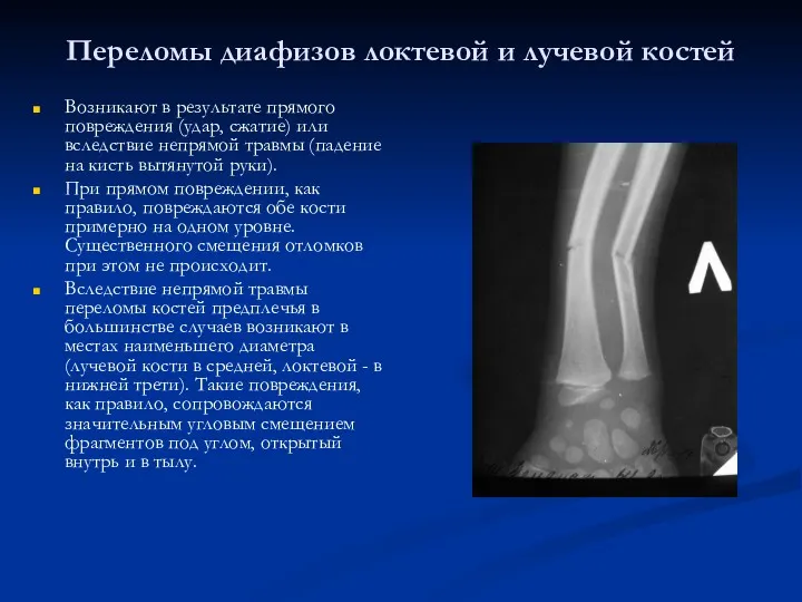 Переломы диафизов локтевой и лучевой костей Возникают в результате прямого повреждения (удар, сжатие)