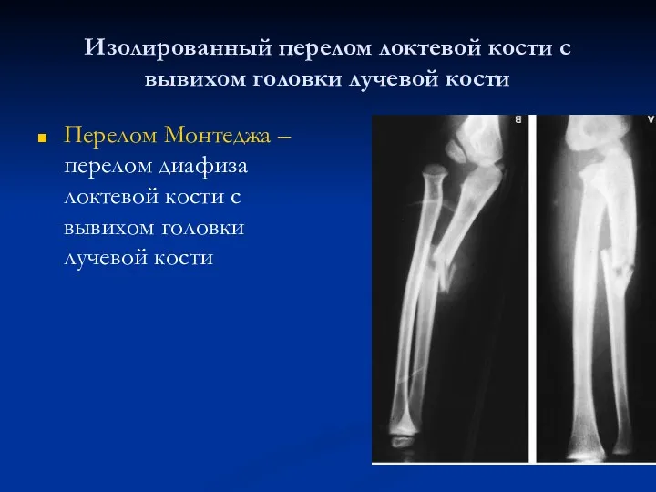 Изолированный перелом локтевой кости с вывихом головки лучевой кости Перелом Монтеджа – перелом