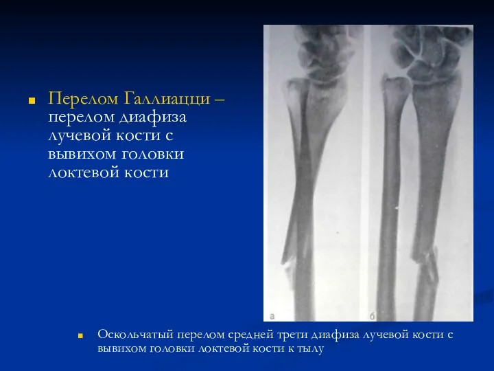Перелом Галлиацци – перелом диафиза лучевой кости с вывихом головки локтевой кости Оскольчатый
