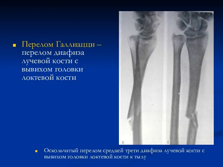 Перелом Галлиацци – перелом диафиза лучевой кости с вывихом головки