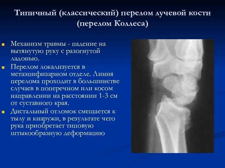 Типичный (классический) перелом лучевой кости (перелом Коллеса) Механизм травмы - падение на вытянутую