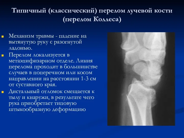 Типичный (классический) перелом лучевой кости (перелом Коллеса) Механизм травмы -