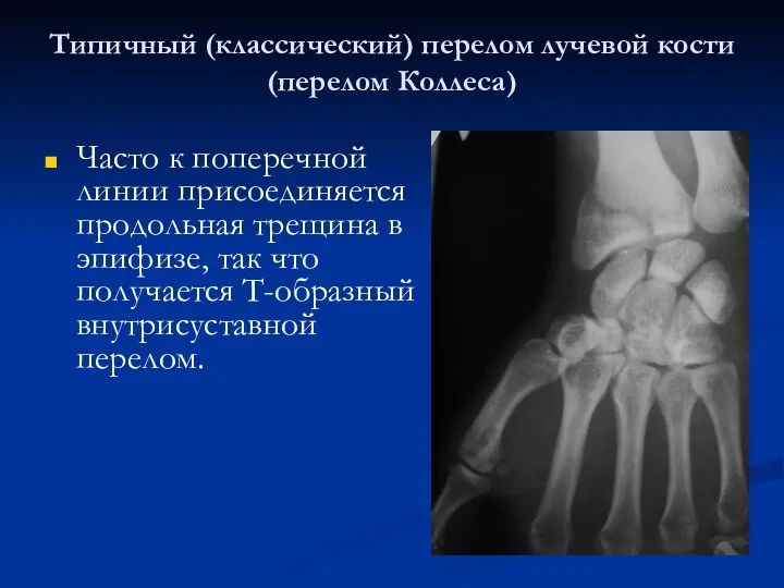 Типичный (классический) перелом лучевой кости (перелом Коллеса) Часто к поперечной линии присоединяется продольная